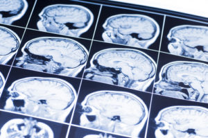 What Happens if a Person Has a Brain Injury?