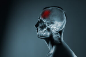 Do I Need to Go to Court for Resolution of My Brain Injury Case?
